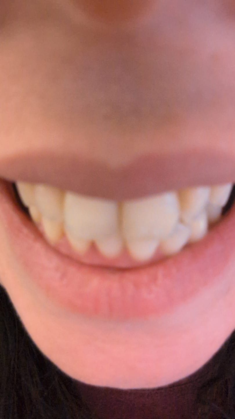 Customer photo review of Pack Ultime : Gel Violet + Bandes Blanchissantes