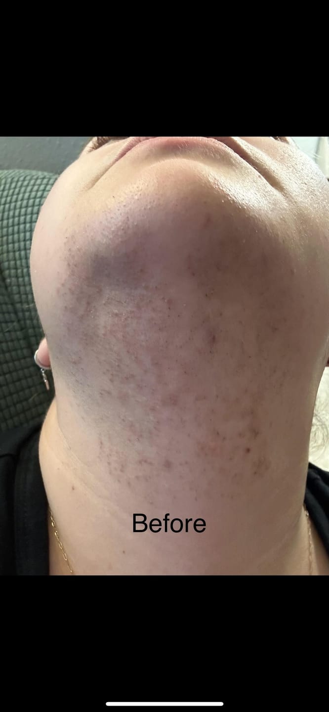 Customer photo review of Hair Reducing Fade Oil - Slows Growth, Thins, and Reduces Hair Naturally
