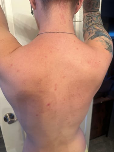 Customer's back with visible zits and irritated skin before using Grass Fed Tallow & Honey Balm.