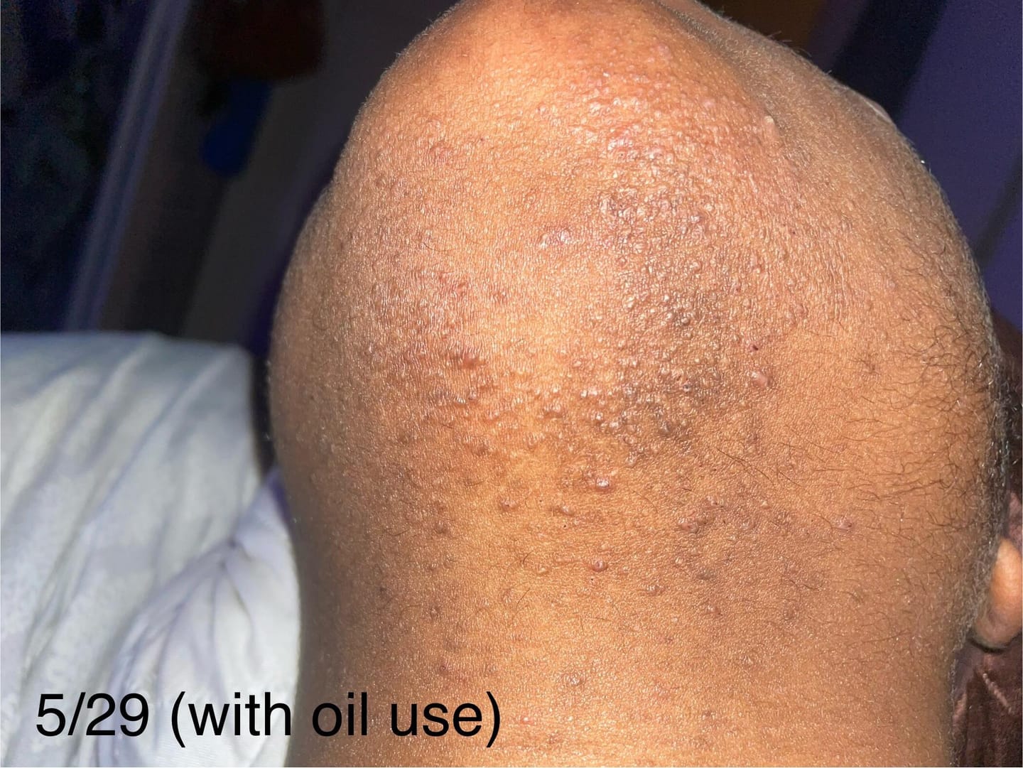 Customer photo review of Hair Reducing Fade Oil - Slows Growth, Thins, and Reduces Hair Naturally