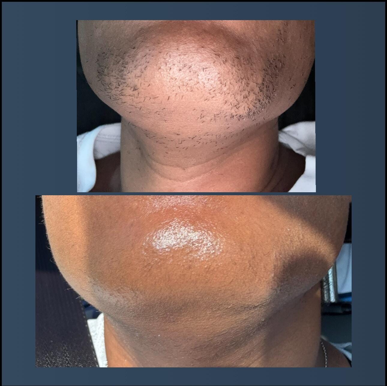 Customer photo review of Hair Reducing Fade Oil - Slows Growth, Thins, and Reduces Hair Naturally