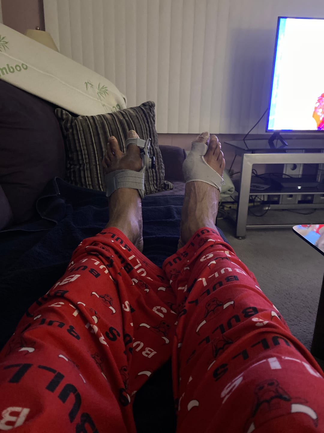 Customer photo review of Treatmedy™ Bunion Fix