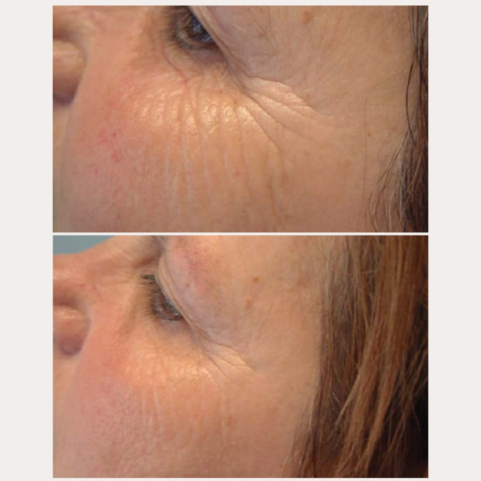Customer photo review of Microneedling - Lifting Power Set – Professionelles Micro-Infusion Treatment für Zuhause
