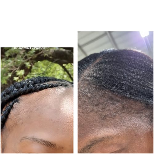 Customer photo review of NOVIFUL HAIR GROWTH FOAM - 50 day supply