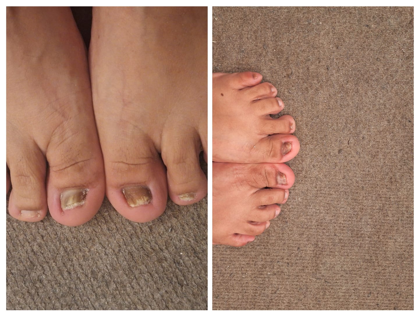 Customer photo review of Kit ByeBye Hongos – Uñas Sanas & Cuidadas