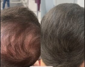 Customer photo review of My-Glamora Haarvuller Poeder – Direct een vollere haarlijn