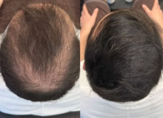 Customer photo review of My-Glamora Haarvuller Poeder – Direct een vollere haarlijn