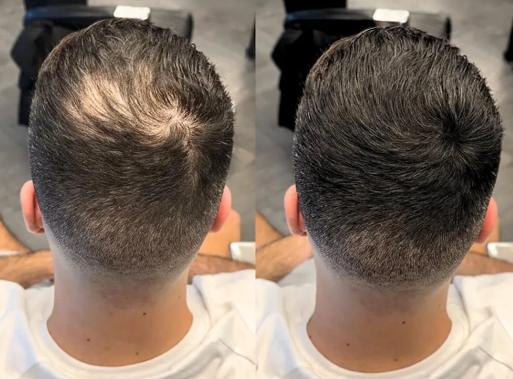 Customer photo review of My-Glamora Haarvuller Poeder – Direct een vollere haarlijn
