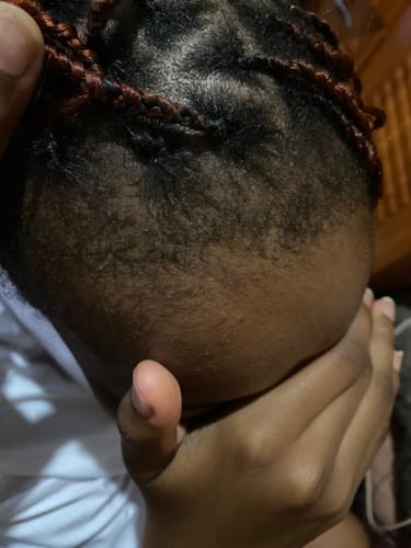 Customer photo review of Minoxidil 5% Solution, 1 Pack 60ml