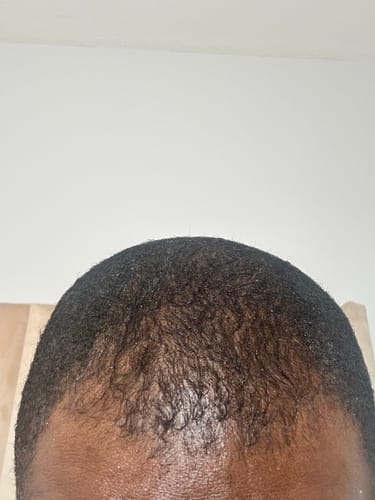 Customer photo review of Minoxidil DOUBLE ACTION Solution - MEN ONLY, 3x60ml pack