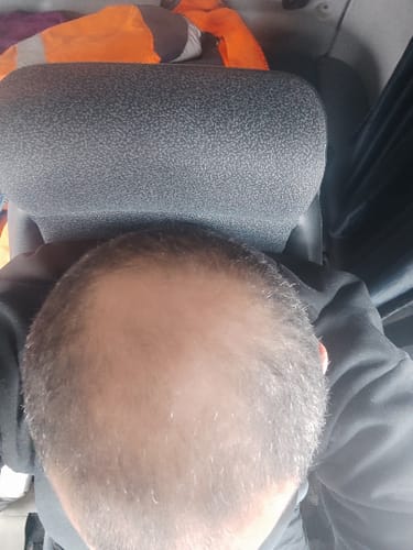 Client montrant le dessus de son crâne avec une calvitie après un mois d'utilisation du Pack d'Odin.