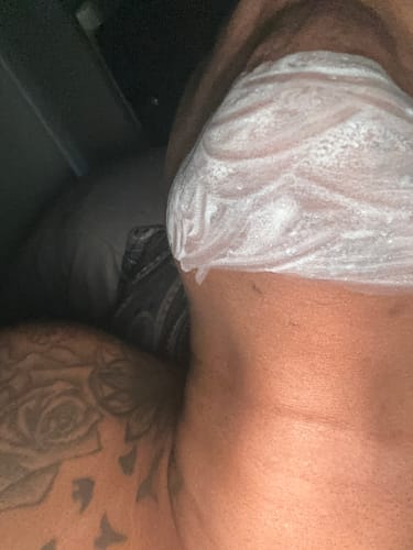 Customer photo review of 1.8% Salicylic Acid Drying Lotion