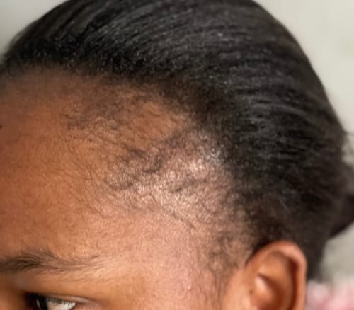 Customer photo review of Minoxidil High Strength (5%) SOLUTION, 3x60ml pack