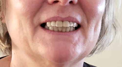 Customer photo review of Facette-Dentaire 3.0