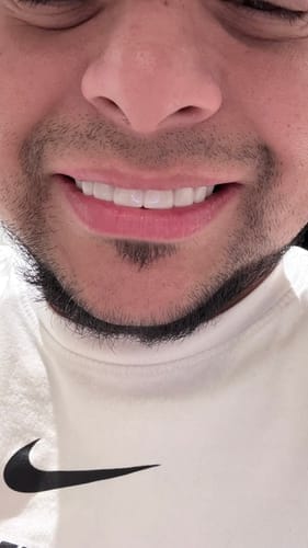 Customer photo review of Faccette-Dentali 3.0
