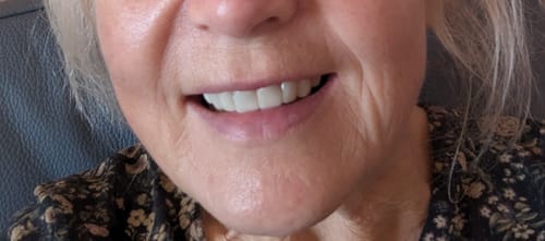 Customer photo review of Faccette-Dentali 3.0
