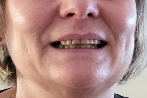 Customer photo review of Faccette-Dentali 3.0
