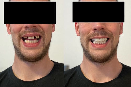 Customer photo review of Faccette-Dentali 3.0