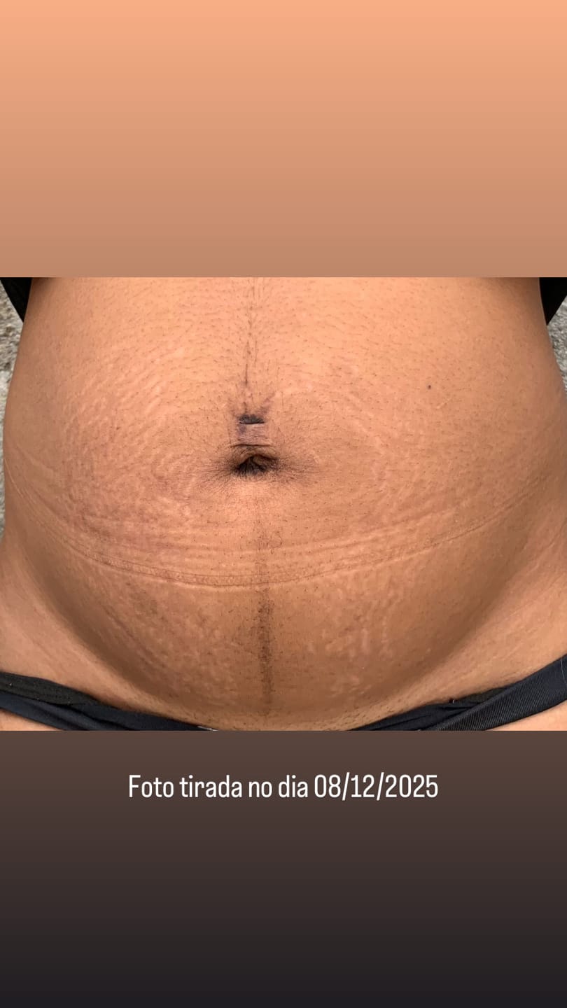 Customer photo review of Daily Tratamento - Creme Para Estrias