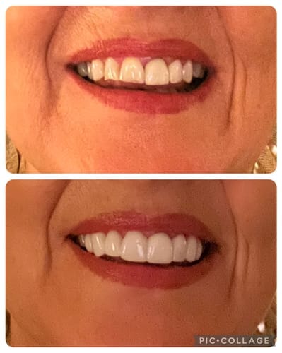 Customer photo review of Faccette-Dentali 3.0