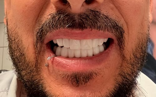 Customer photo review of Faccette-Dentali 3.0