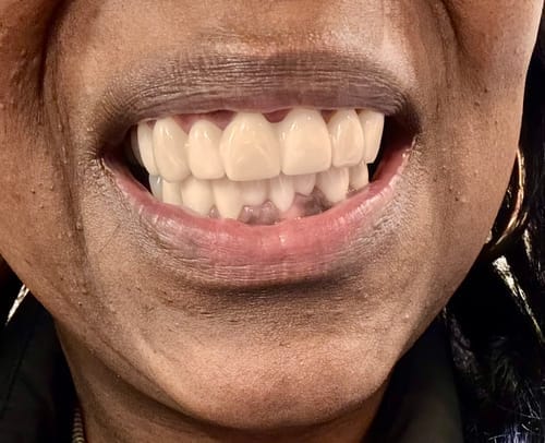 Customer photo review of Facette-Dentaire 3.0