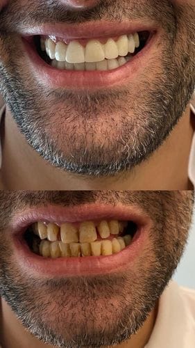 Customer photo review of Facette-Dentaire 3.0