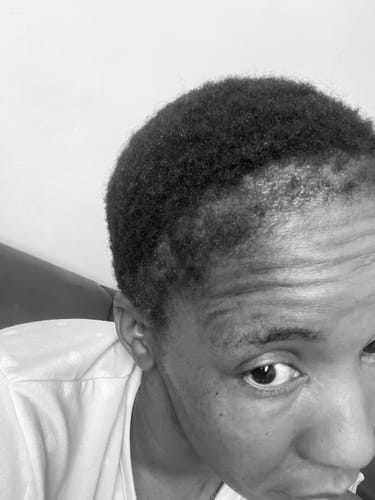 Customer photo review of Minoxidil 5% SOLUTION, 3 x 60ml pack