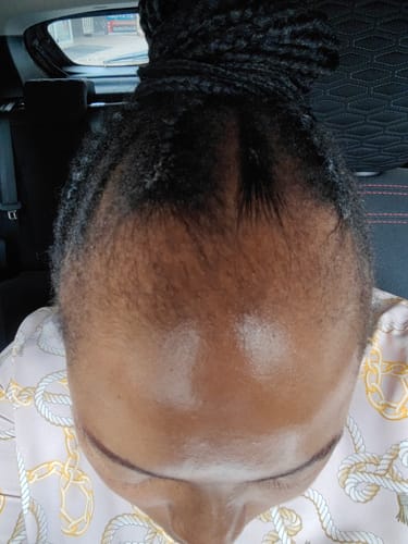 Customer photo review of Minoxidil 5% Solution, 1 Pack 60ml