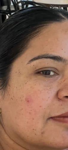 Close-up of a reviewer's skin showing pigmentation and redness before using the Vitamin C serum.