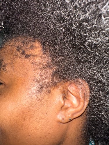 Customer photo review of Minoxidil 5% Solution, 1 Pack 60ml