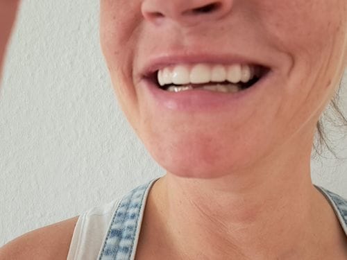 Customer photo review of Faccette-Dentali 3.0