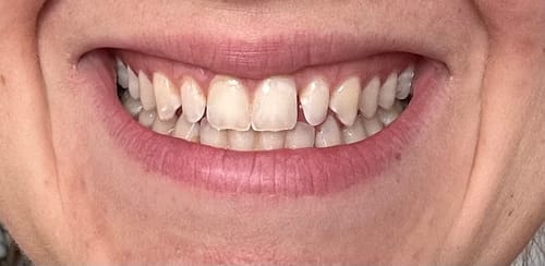 Customer photo review of Faccette-Dentali 3.0