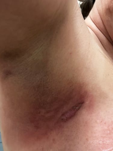 Customer photo review of Radiation Relief Cream – Unscented Burn Cream for Radiation Therapy