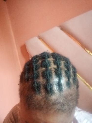 Customer photo review of Minoxidil REGULAR (2%) strength FOAM, 3x60ml Pack