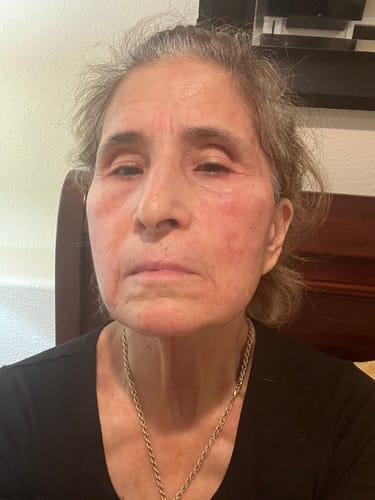 A close-up of the reviewer's face, showing some redness after using the Seranova Microneedling Infusion System.