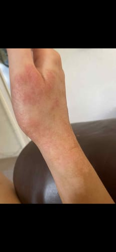 Close-up of a reviewer's hand with red, sore skin before using Calm Balm.