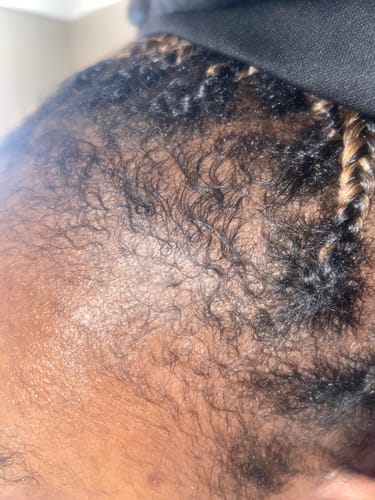 Customer photo review of Minoxidil High Strength (5%) FOAM, 3x60ml pack