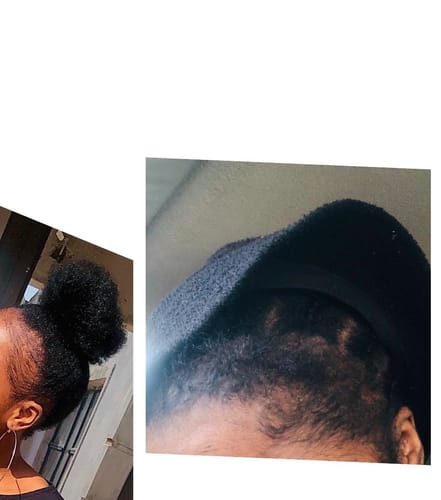 Customer photo review of Minoxidil 5% Solution, 1 Pack 60ml