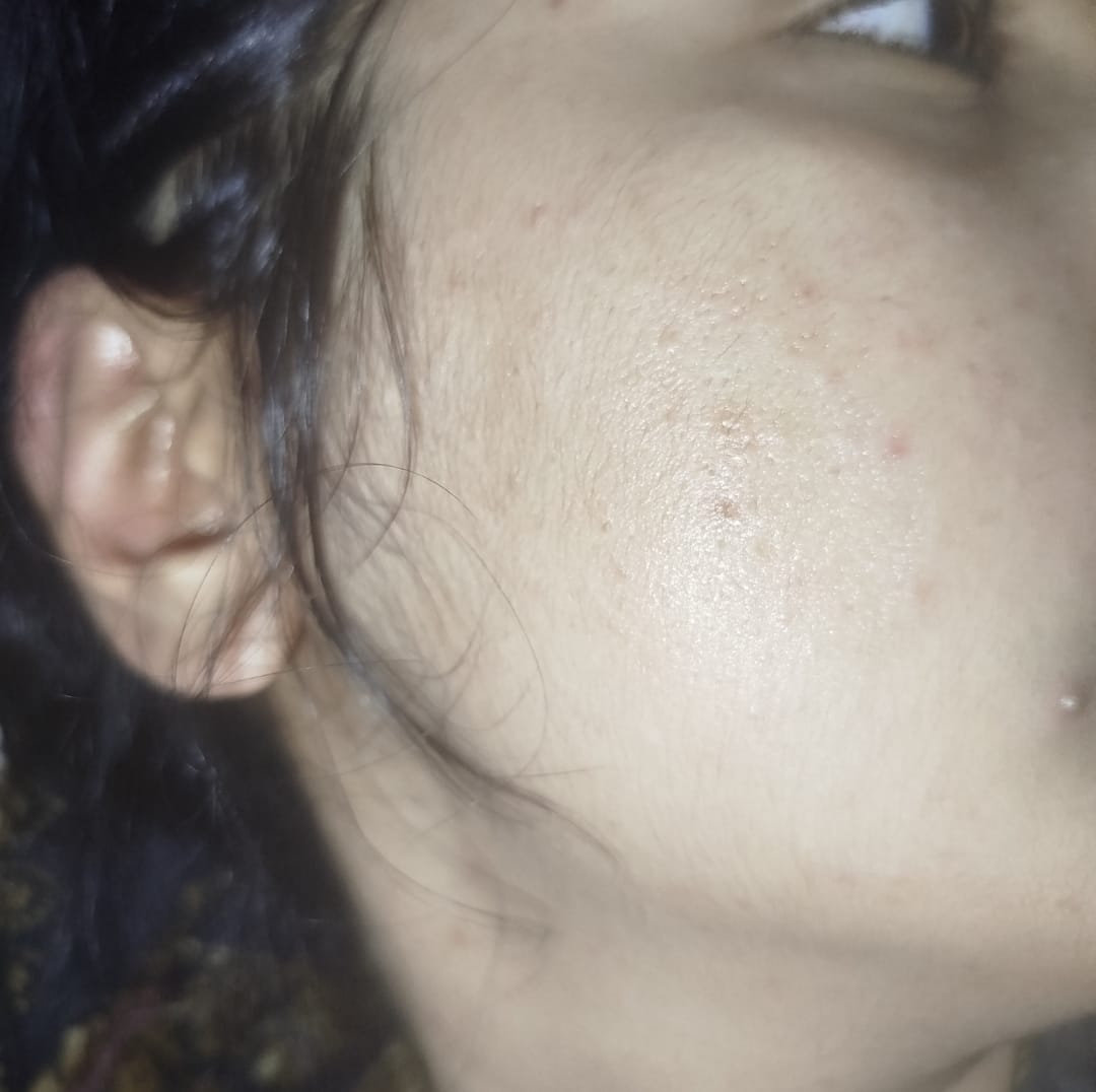 Customer photo review of NiaRonic Serum (Pore Minimizing)