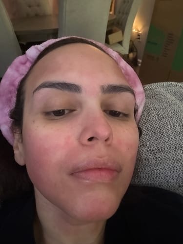 Reviewer's face showing red skin after a Glov Micro Infusion System treatment.