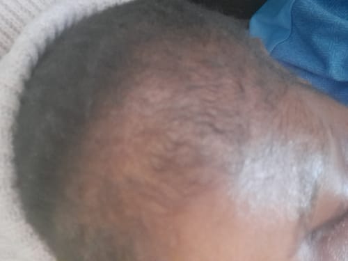 Customer photo review of Minoxidil High Strength (5%) SOLUTION, 3x60ml pack