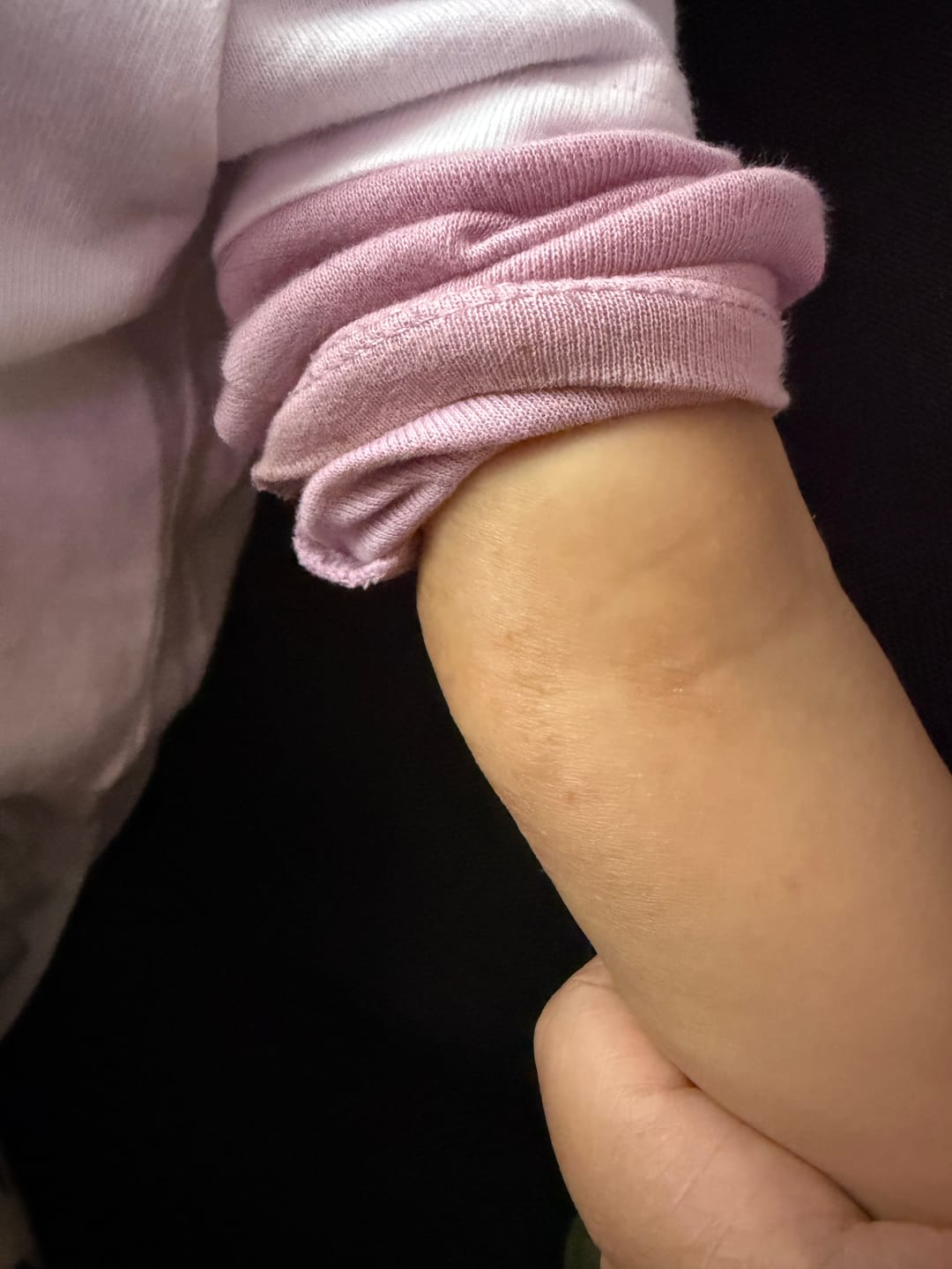 Customer photo review of Bioskin Junior Outbreak Rescue Cream