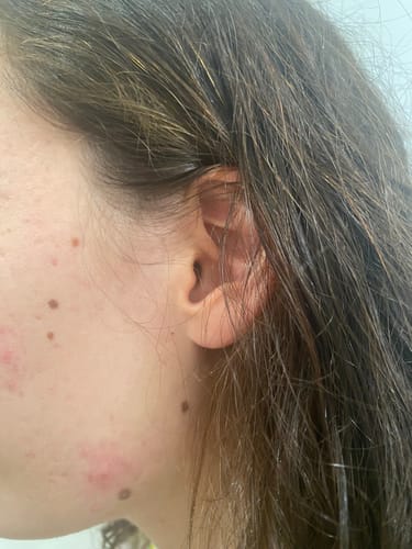 Reviewer shows a close-up of their cheek with healing acne spots after using Pimple Pals.