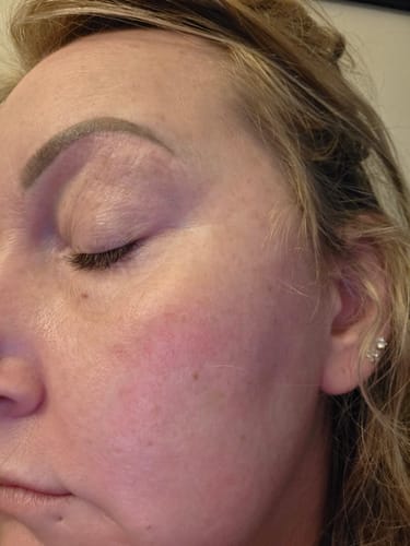 Close-up of a customer's cheek, showing their improved complexion after using The Micro Infusion System.