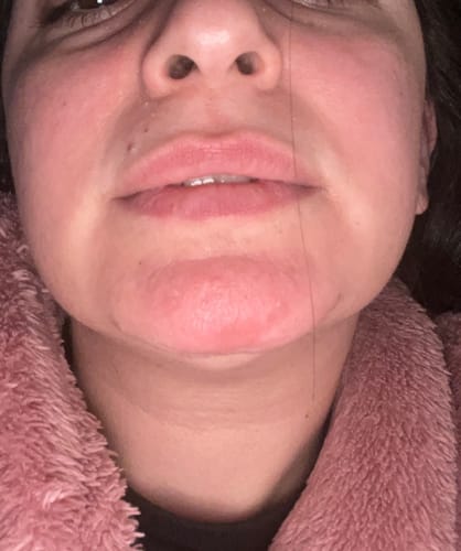 Close-up: Reviewer's red, irritated skin before using the Sea Buckthorn Serum.