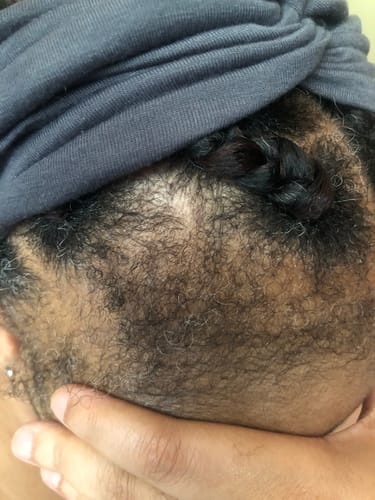 Customer photo review of Minoxidil High Strength (5%) SOLUTION, 3x60ml pack