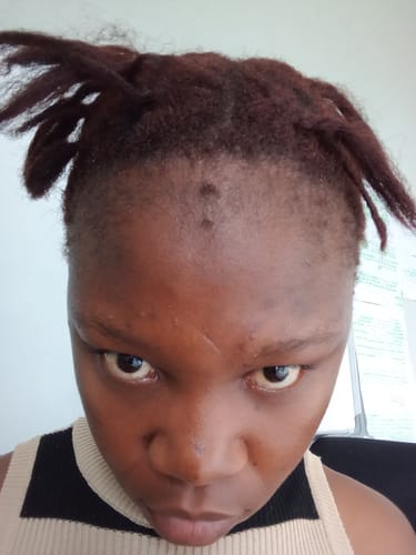 Customer photo review of Minoxidil High Strength (5%) SOLUTION, 3x60ml pack