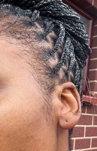 Customer photo review of Minoxidil High Strength (5%) FOAM, 3x60ml pack