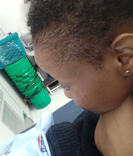 Customer photo review of Minoxidil 5% Solution, 1 Pack 60ml